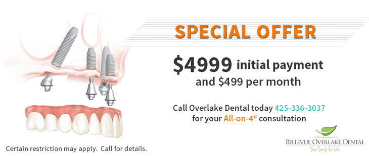 All on 4 Special Offer | Bellevue Overlake Dental